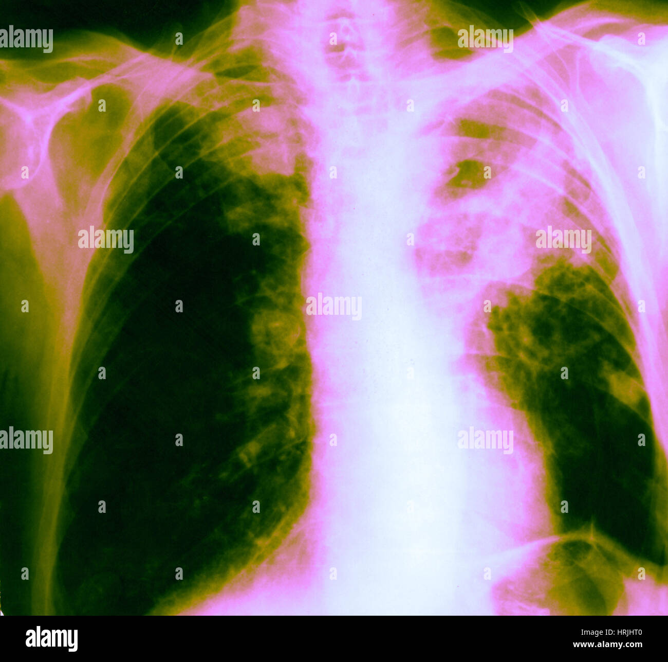 Xray of Lung Cancer Stock Photo Alamy