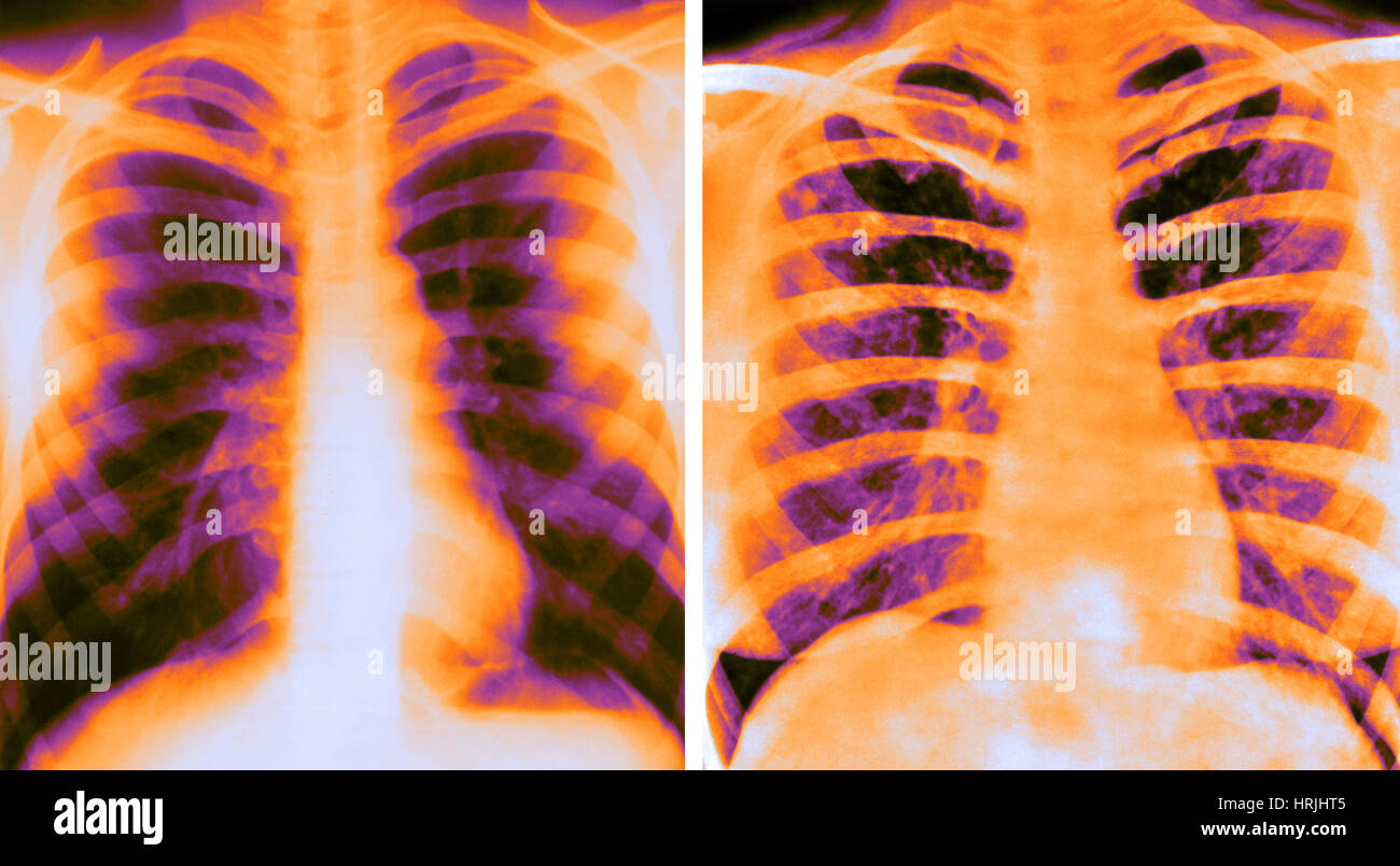Normal and Cancerous Lungs, Xray Stock Photo Alamy