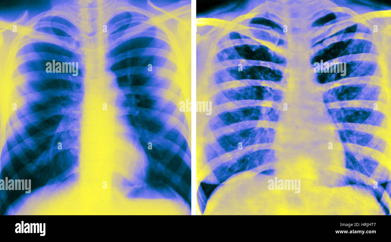 Normal lungs x ray hires stock photography and images Alamy