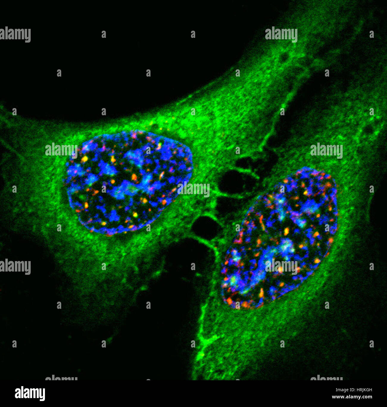 Tumour cells micrograph hi-res stock photography and images - Alamy