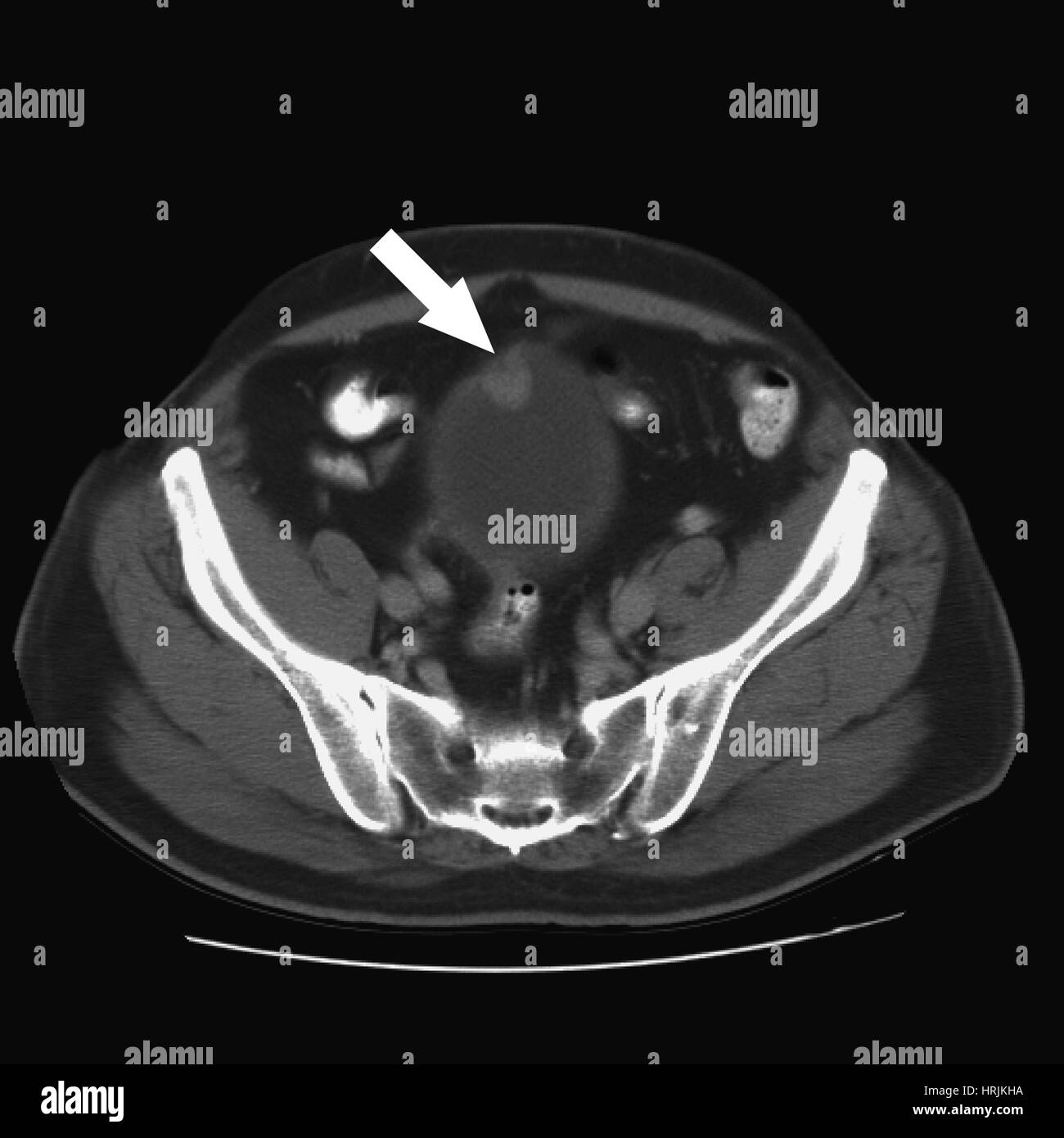 Bladder Cancer CT Stock Photo Alamy bladder-cancer-ct-stock-photo-alamy