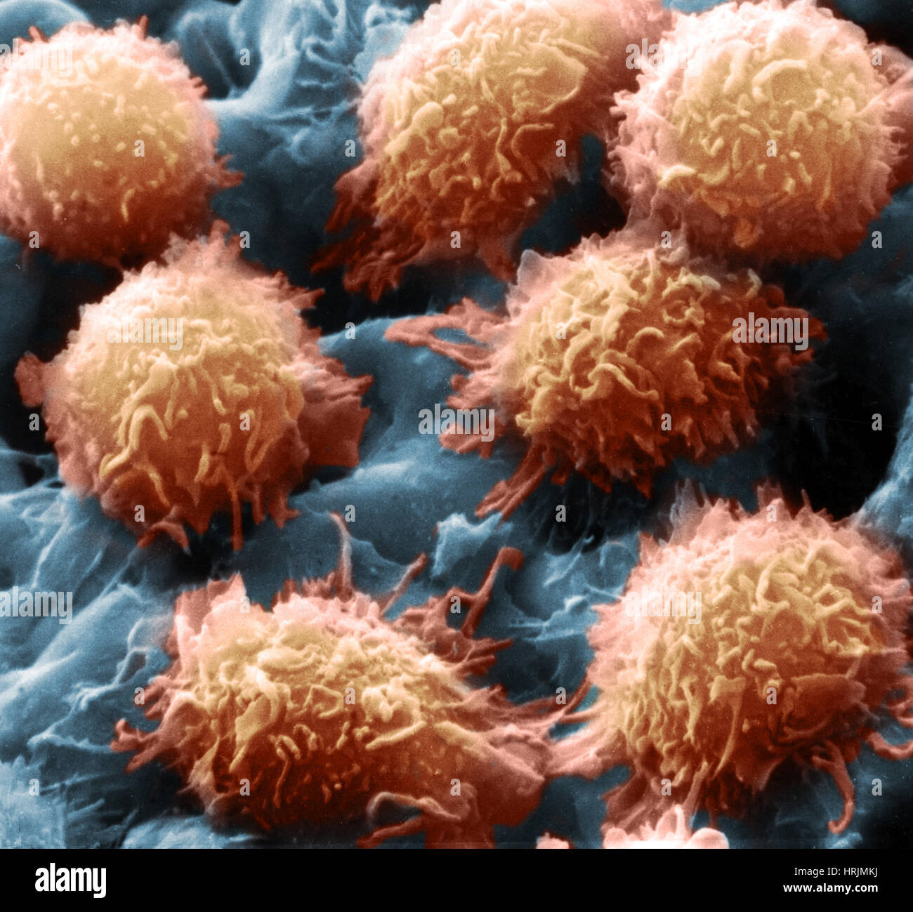 hairy-cell-leukemia-sem-stock-photo-alamy