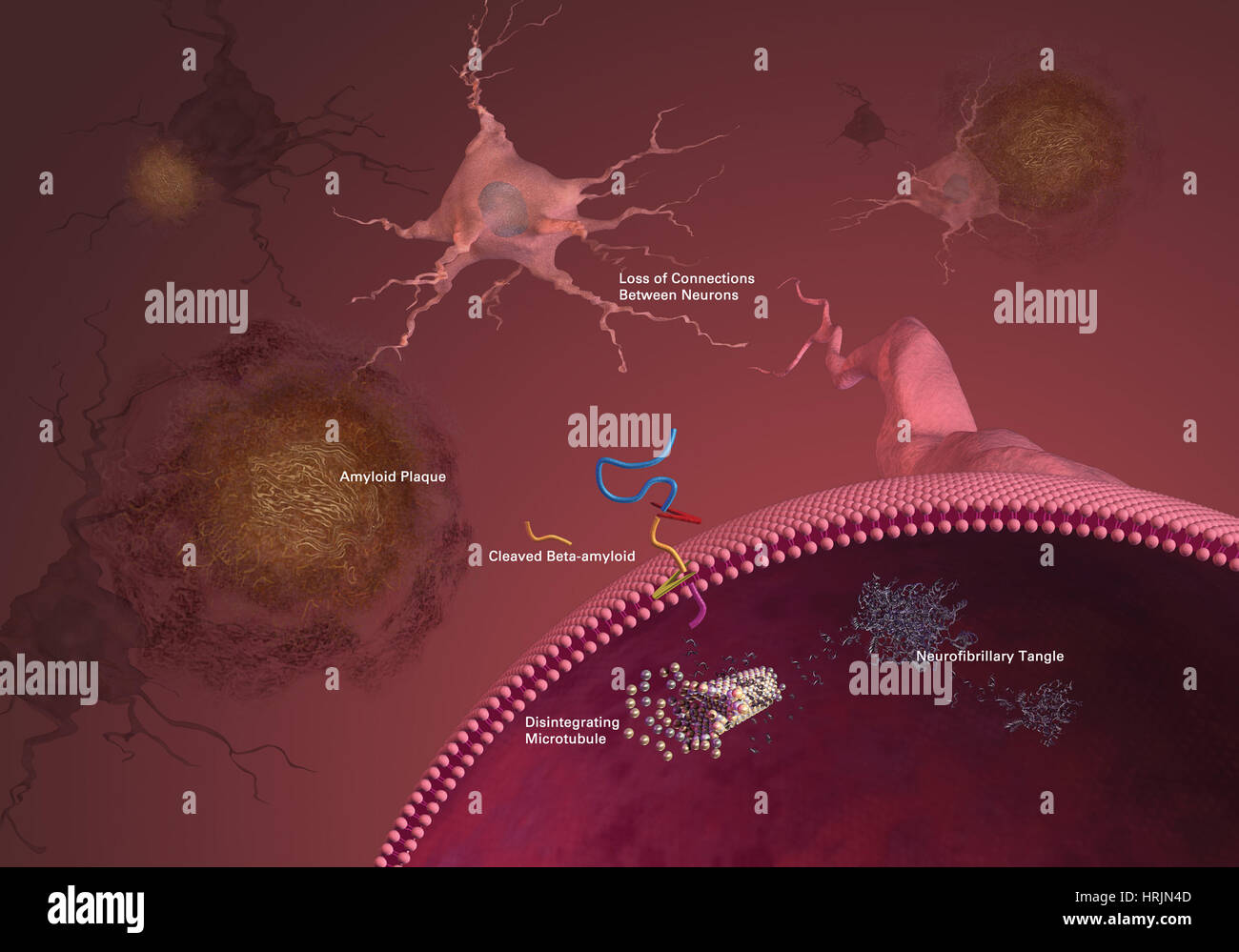 Characteristics of Alzheimer's Disease Stock Photo