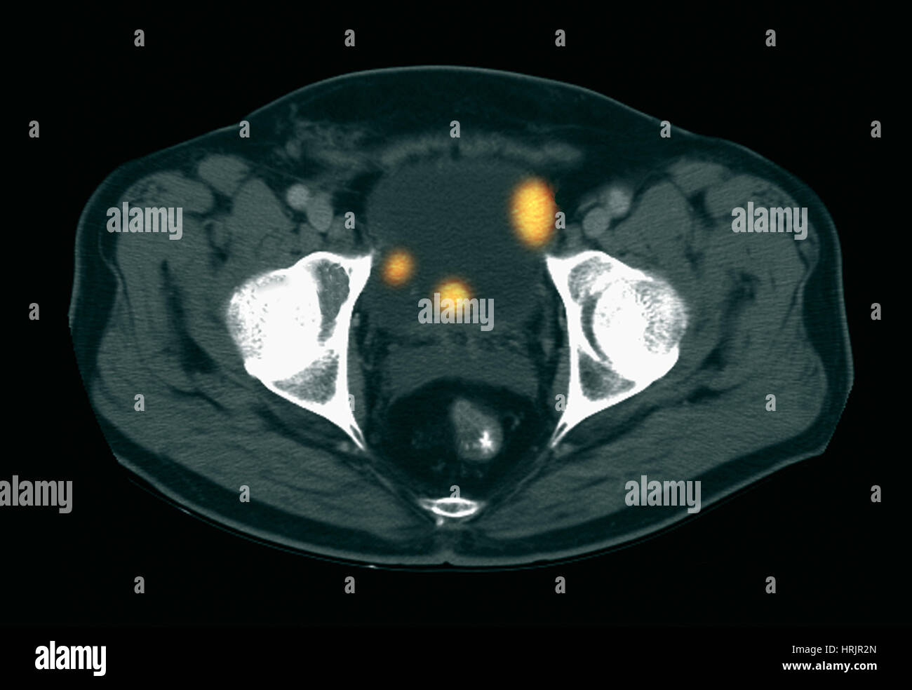 bladder-cancer-ct-scan-stock-photo-alamy