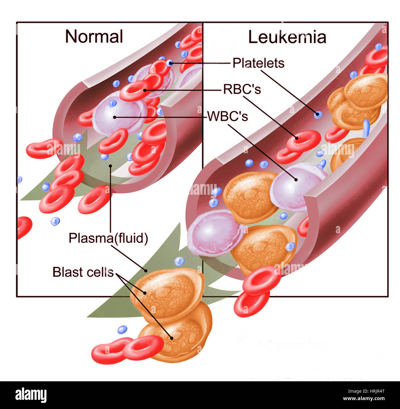 Normal Blood Cells and Leukemia Stock Photo Alamy