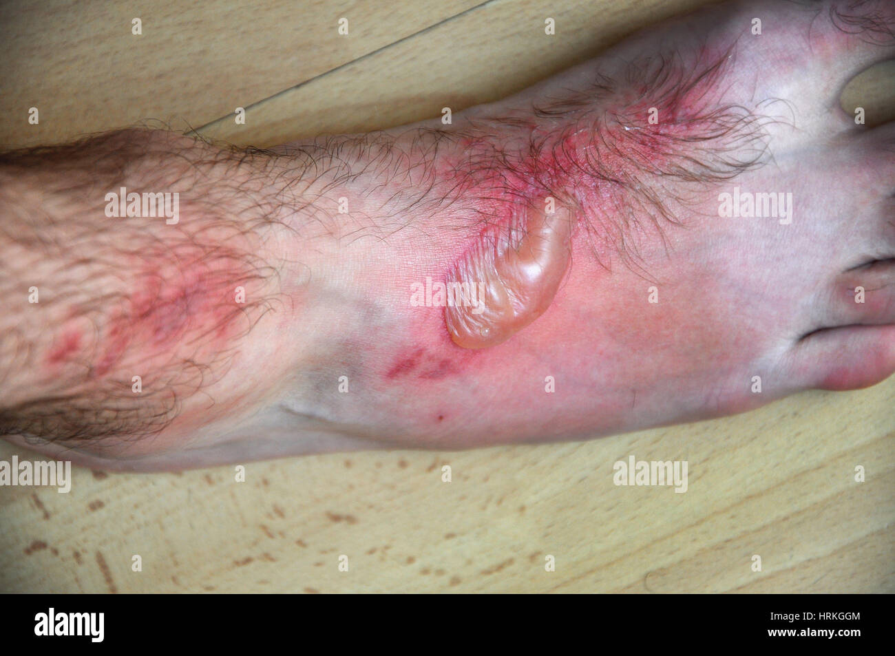 Phytophotodermatitis, cutaneous phototoxic skin inflammatory eruption from a plant named Dictamnus albus Stock Photo