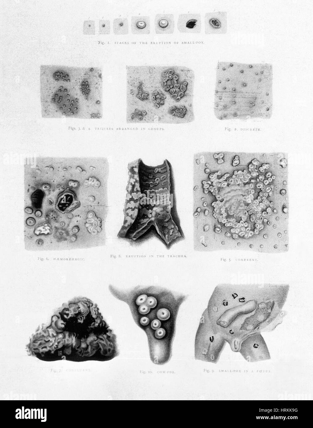 Stages and Types of Smallpox Stock Photo Alamy
