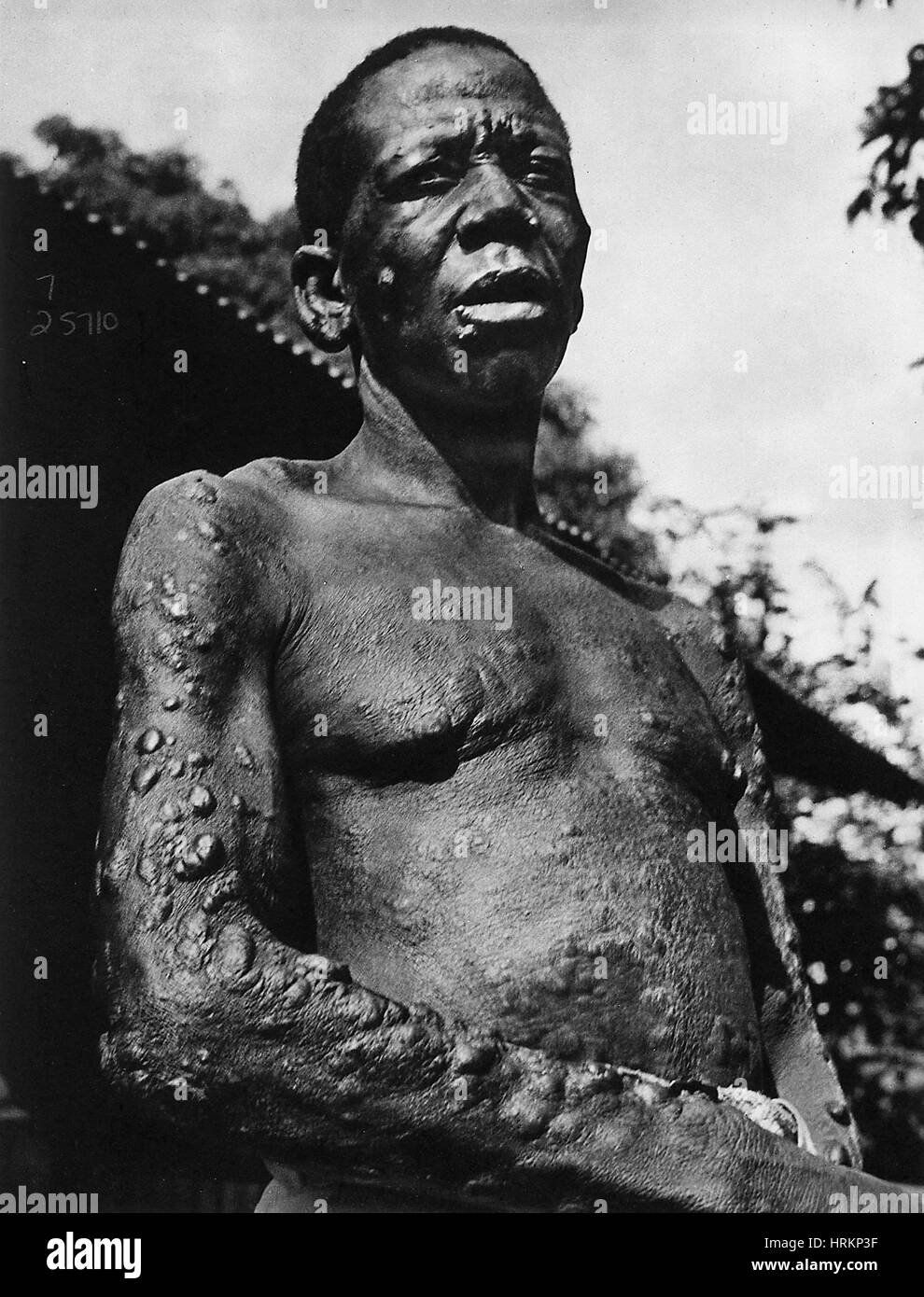 Leprosy Stock Photo