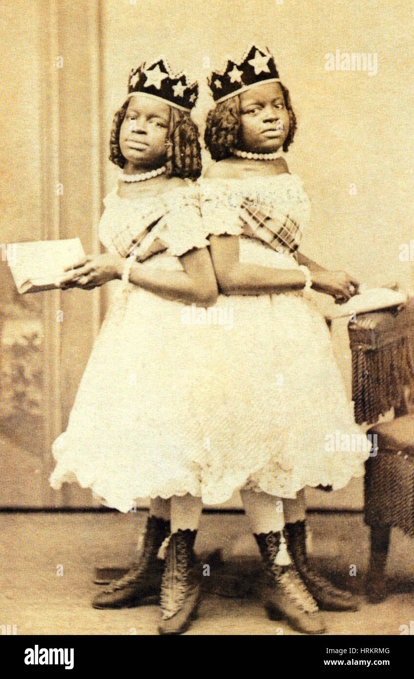 The McCoys, Conjoined Twins Stock Photo