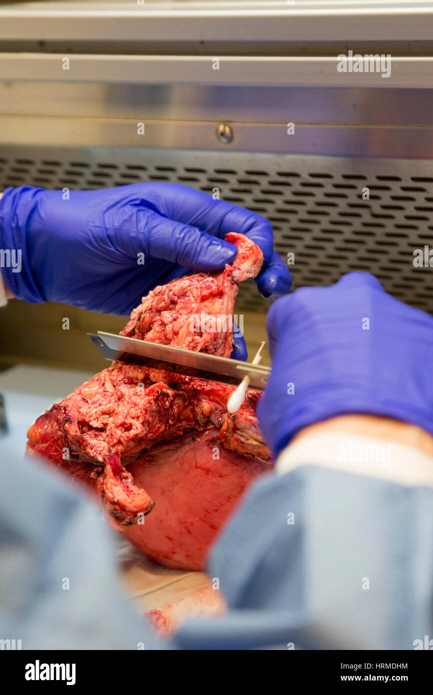 Detroit, Michigan - A pathology assistant at the Detroit Medical Center examines a uterus with endometrial adenocarcinoma. Stock Photo