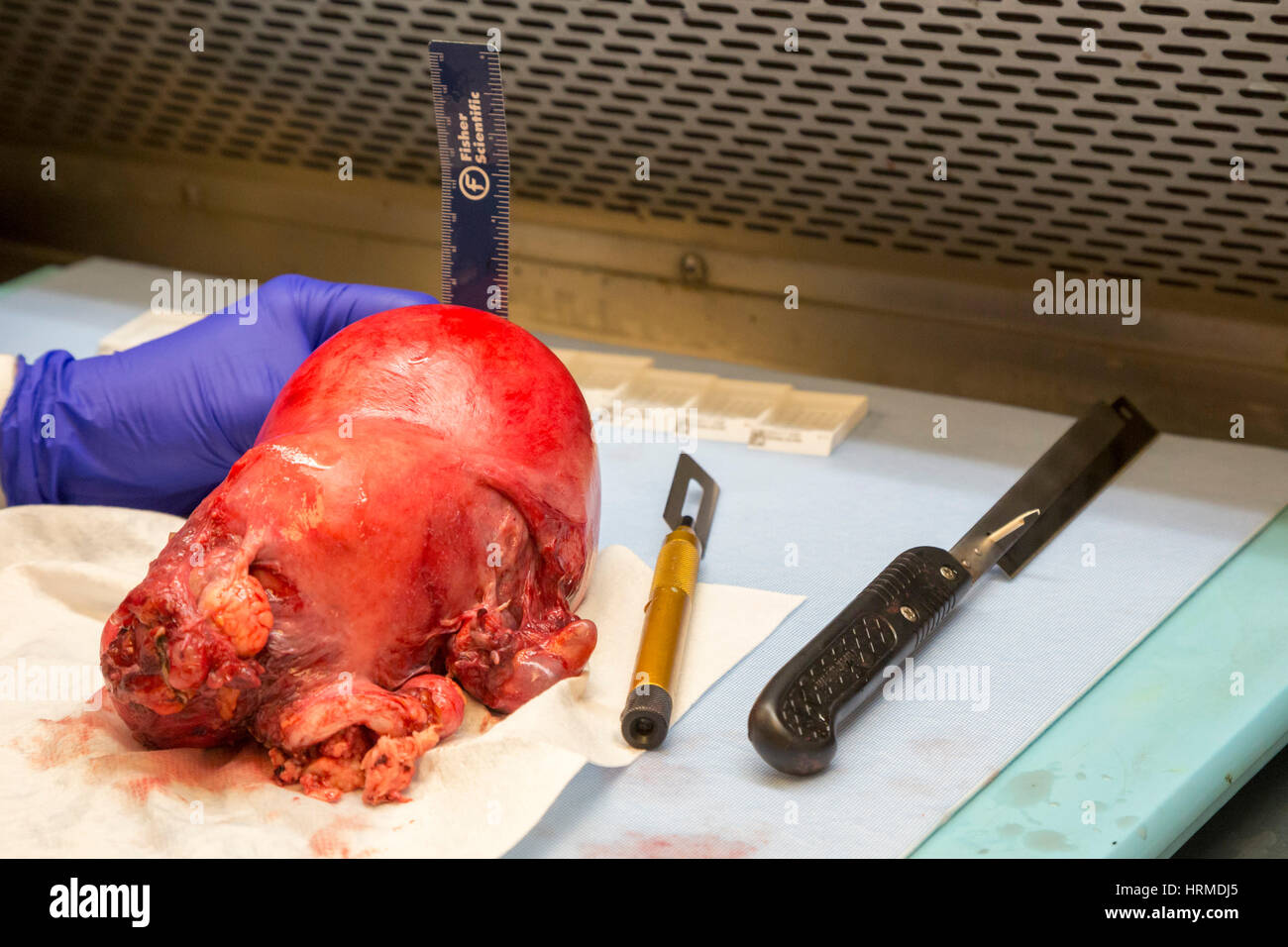 Detroit, Michigan - A pathology assistant at the Detroit Medical Center examines a uterus with endometrial adenocarcinoma. Stock Photo
