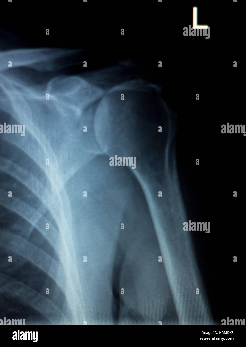 Rib Fracture High Resolution Stock Photography and Images Alamy