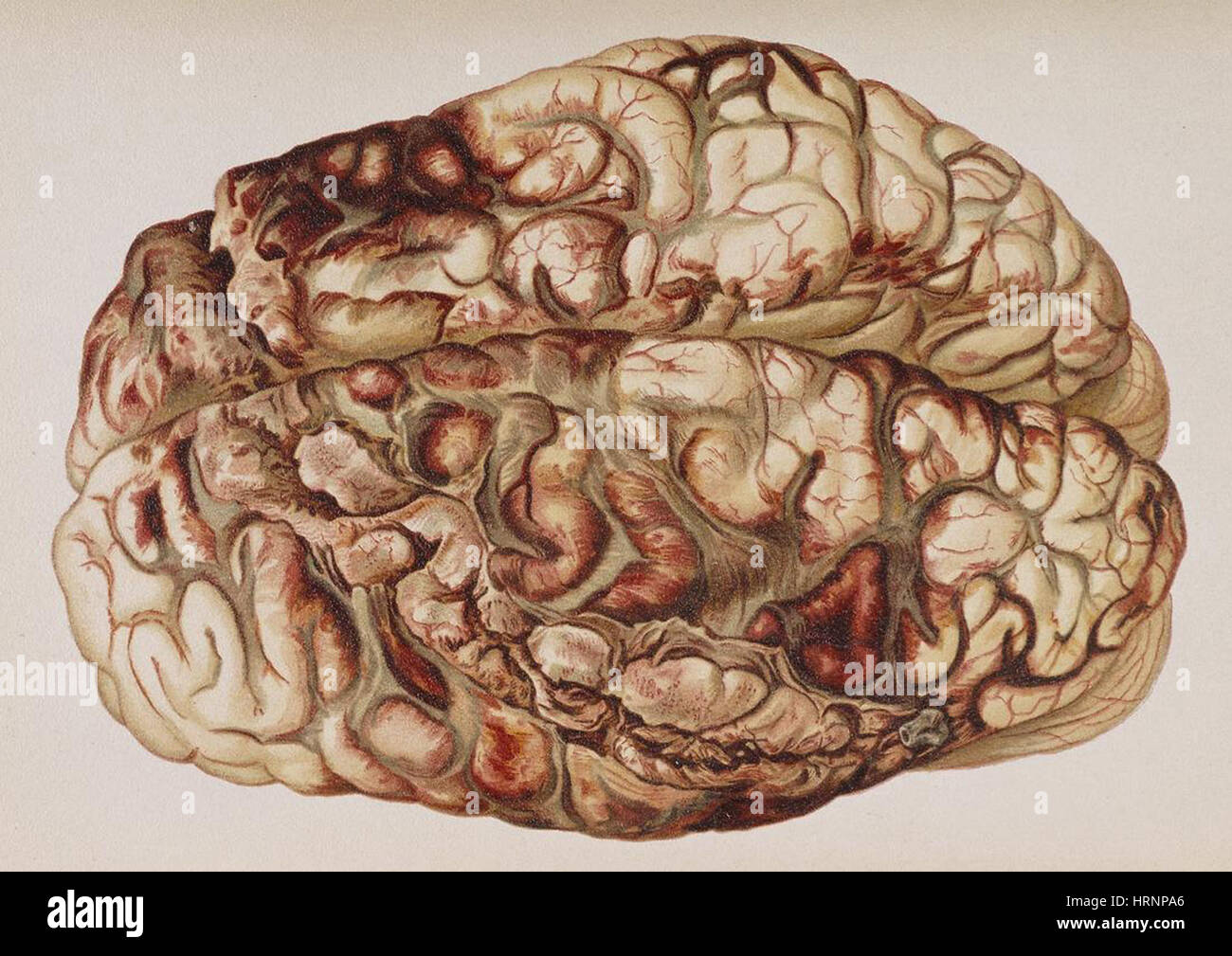 Encircling Gunshot-Wound in Brain, 1898 Stock Photo