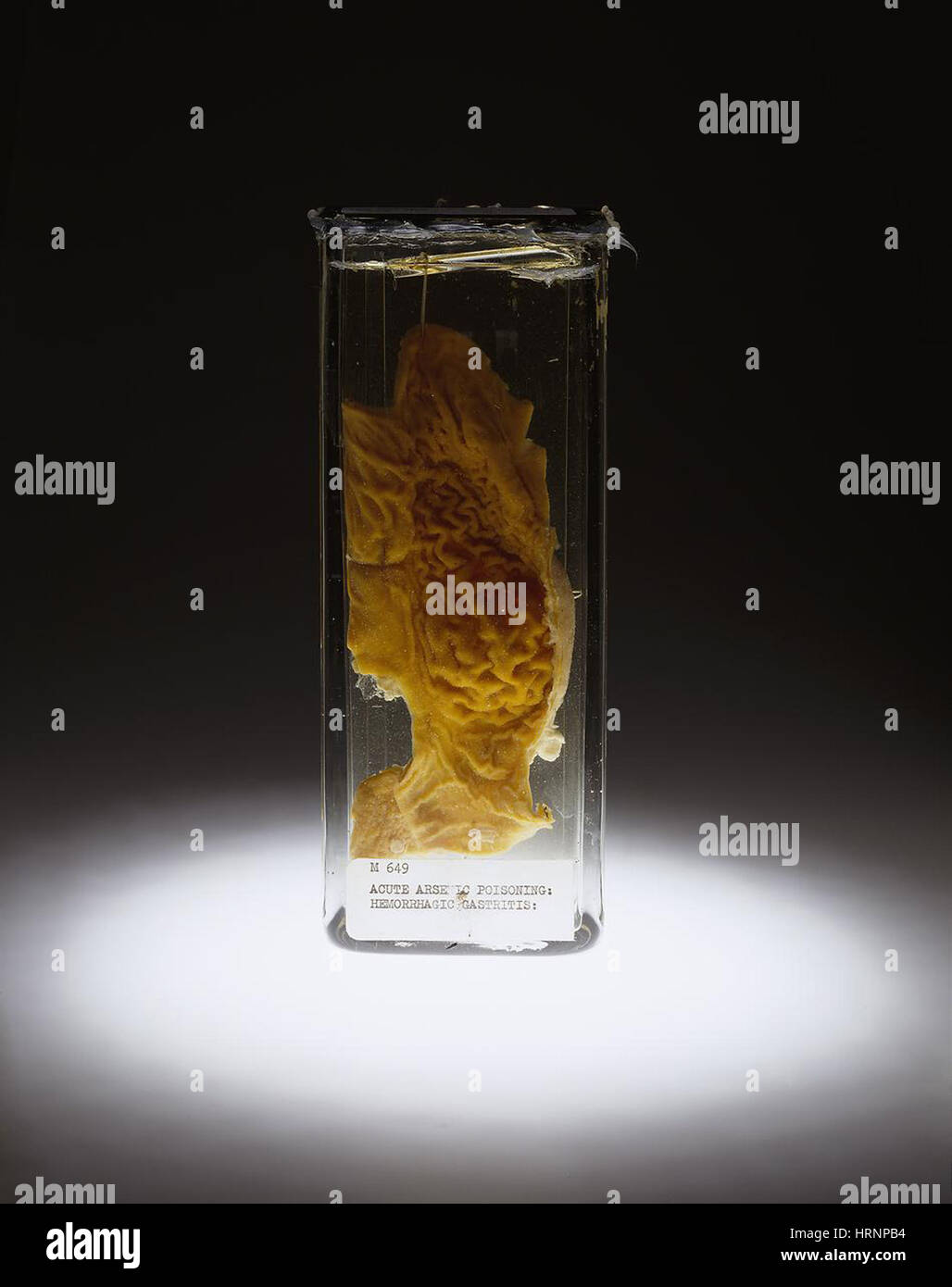 Stomach Hemorrhagic Gastritis Arsenic Poisoning 1934 Stock Photo Alamy