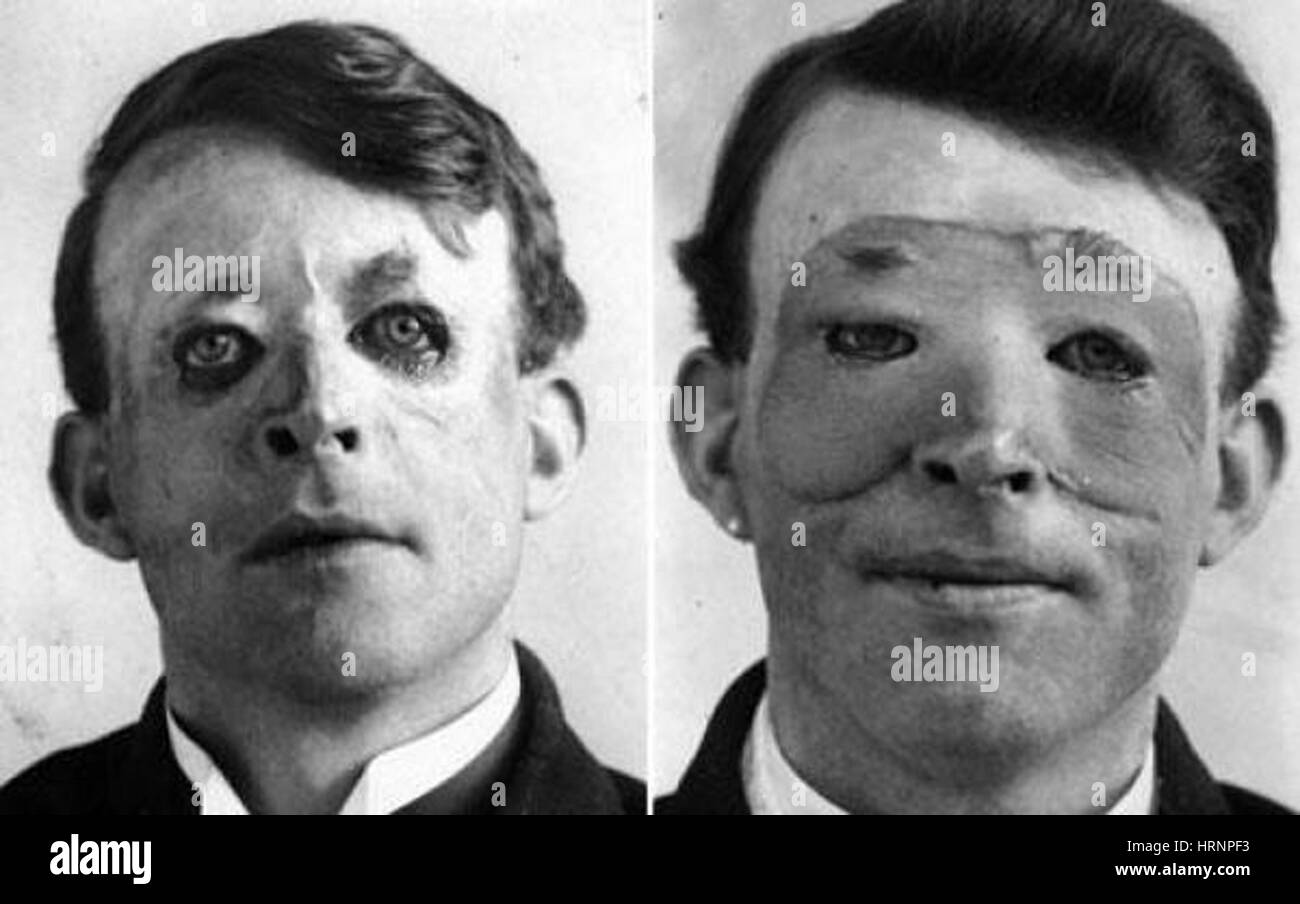 Walter Yeo, WWI Plastic Surgery Patient Stock Photo