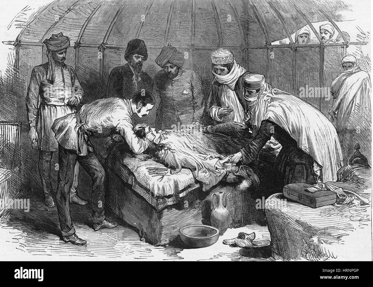 Burn Surgery, 1885 Stock Photo