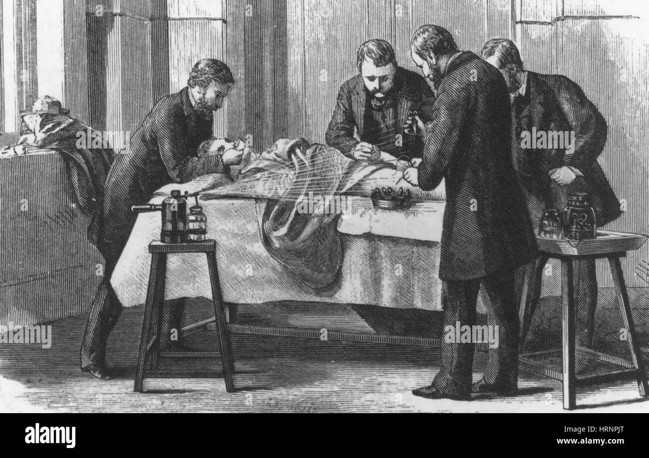 Lister's Antiseptic Spray, Surgery, 19th Century Stock Photo