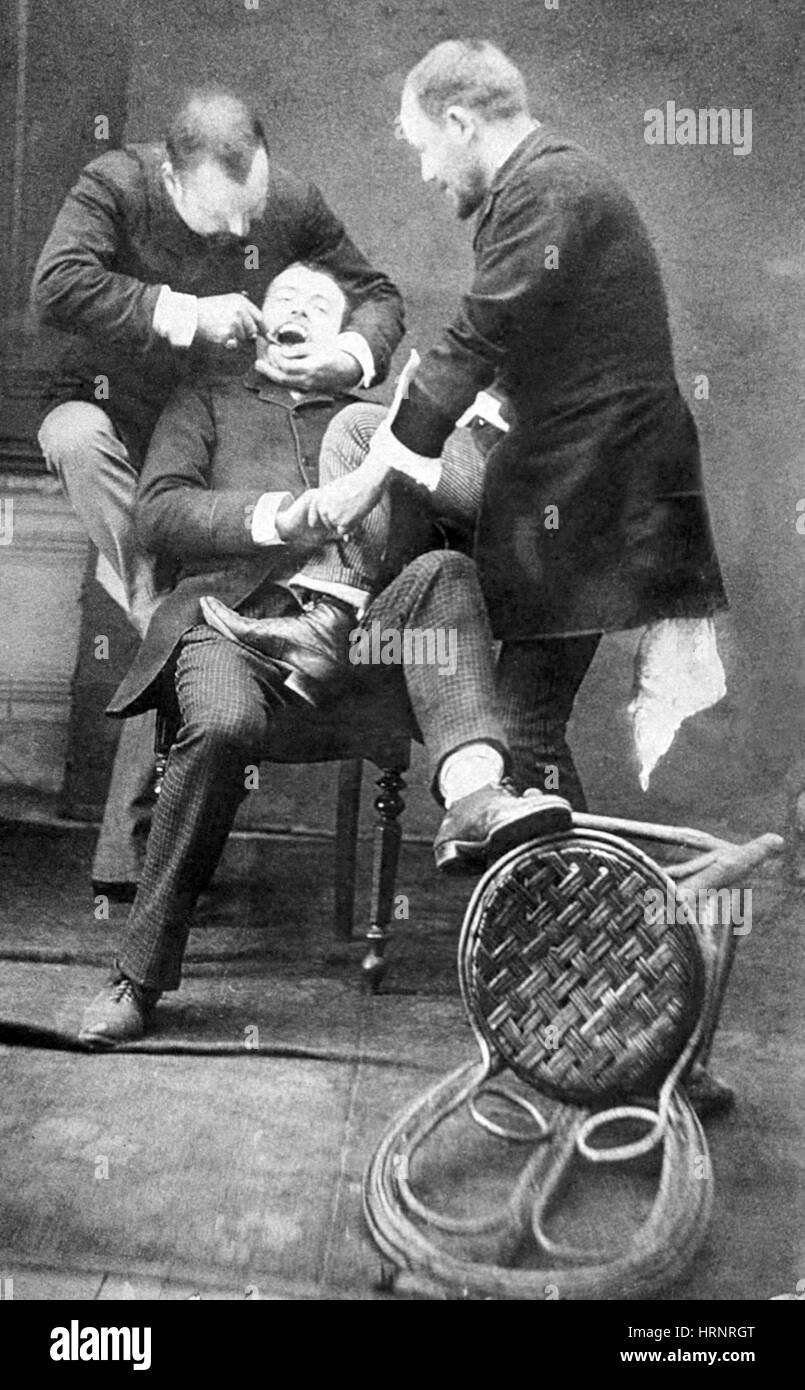 Dentistry, Tooth Extraction, 1892 Stock Photo