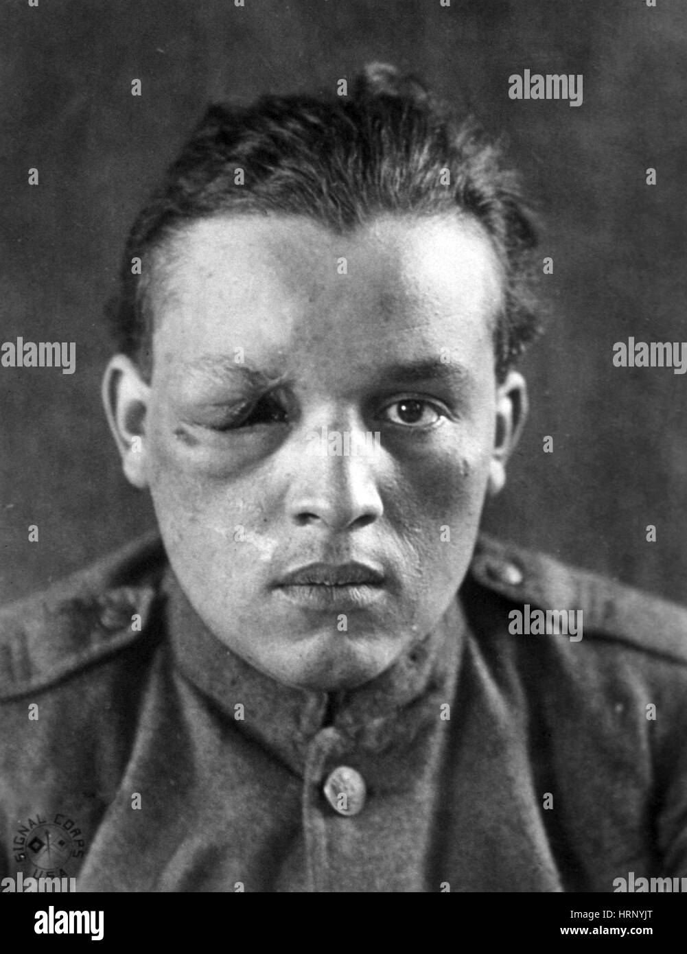 WWI, Wounded Soldier Stock Photo