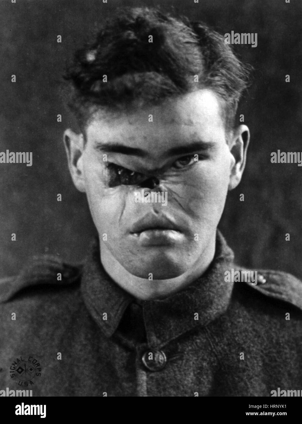 WWI, Wounded Soldier Stock Photo