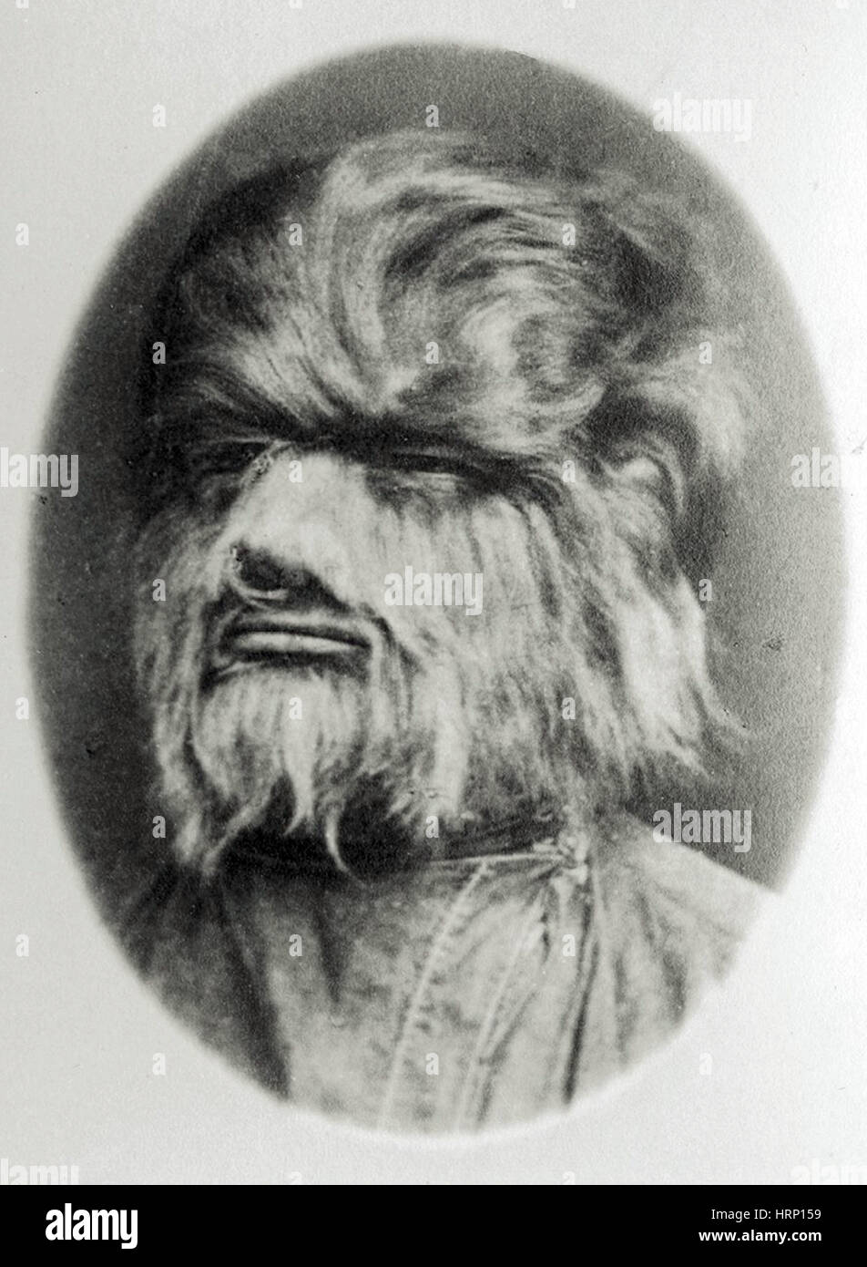 Hypertrichosis, 19th Century Stock Photo