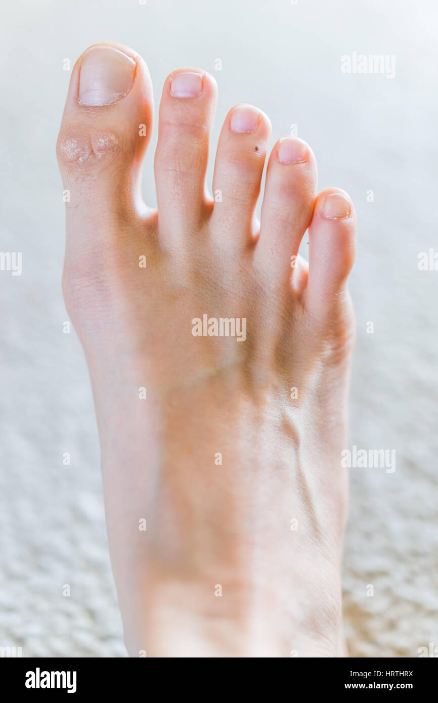 Closeup of female foot with mole on toe Stock Photo
