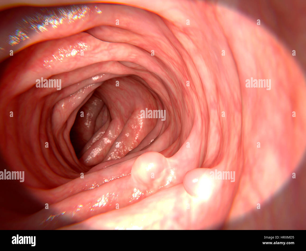 Computer illustration of polyps in the intestine. Polyps are small benign (non-cancerous) growths that arise from the mucus lining of the intestine. Polyps should be surgically removed as they may become malignant (cancerous). Stock Photo