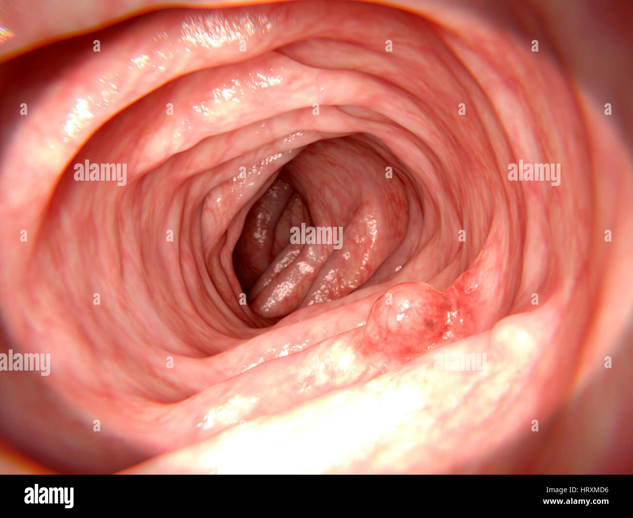 Computer illustration of an adenomatous polyp in the intestine. Polyps are abnormal growths that arise from the mucus lining of the intestine. Although adenomatous polyps start off benign (non-cancerous), as they grow they almost always become malignant (cancerous). Stock Photo