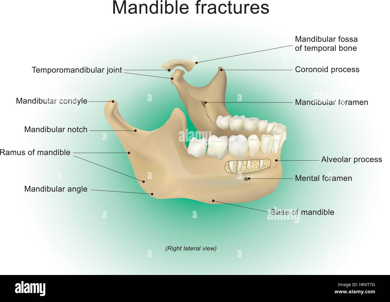 Mandible fractures is the largest, strongest and lowest bone in the face, Vector design, Arts, Illustration. Stock Vector