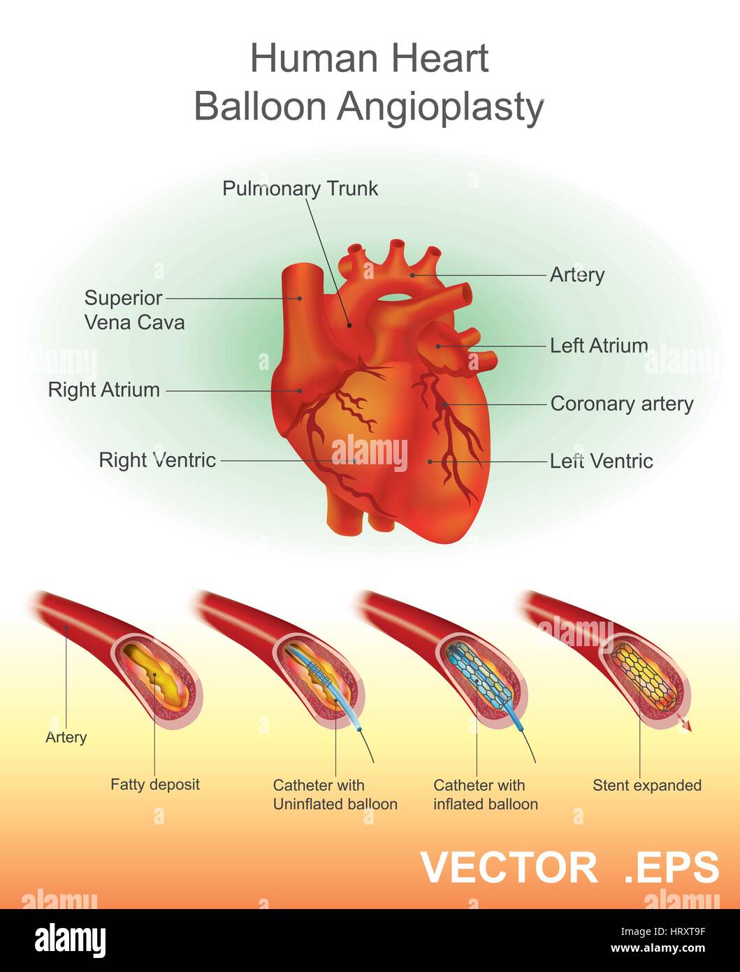 Angioplasty (or Balloon angioplasty) is an endovascular procedure to widen narrowed or obstructed arteries or veins, typically to treat arterial ather Stock Vector
