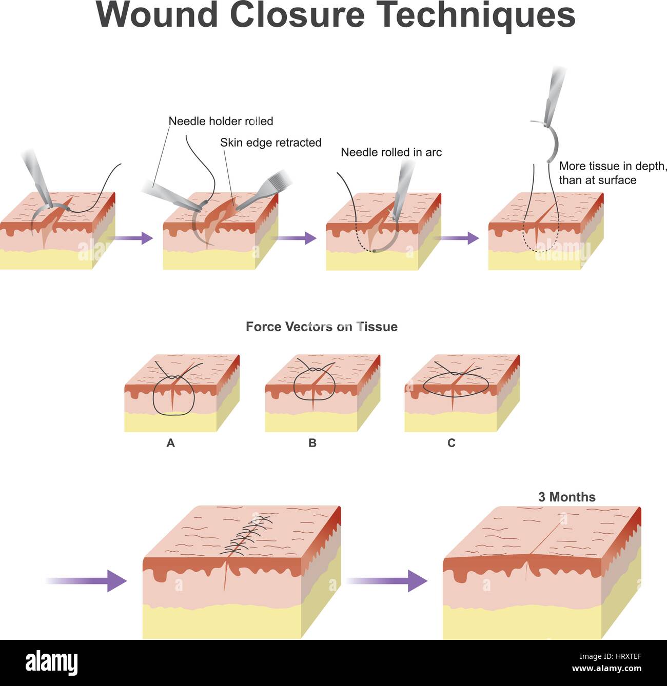 A wound is a type of injury which happens relatively quickly in which skin is torn, cut, or punctured (an open wound), or where blunt force trauma cau Stock Vector