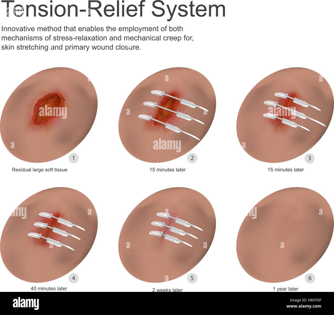 Tension relief system is an innovative method that enables the employment mechanisms of stress-relaxation and mechanical creep for skin stretching. Stock Vector