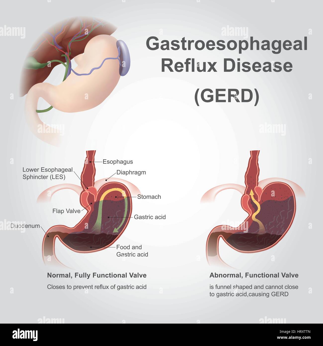 Gastroesophageal reflux disease (GERD), also known as acid reflux, is a long term condition where stomach contents come back up into the esophagus res Stock Vector