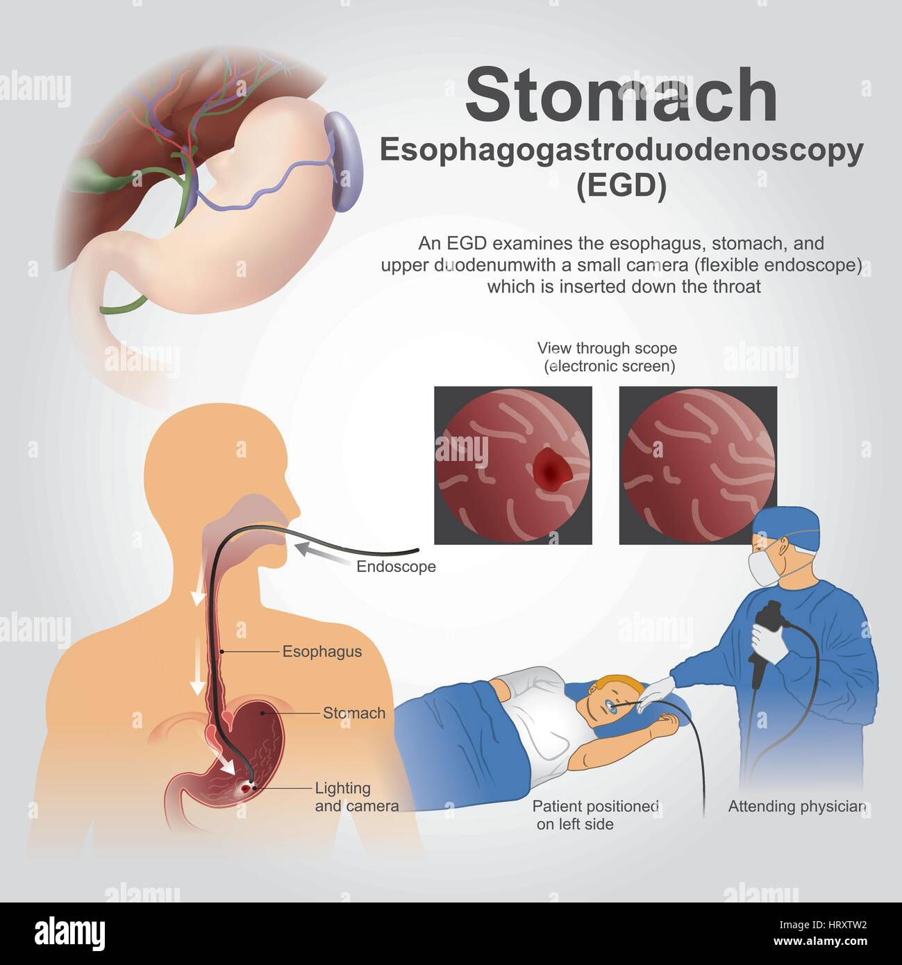 Esophagogastroduodenoscopy, also called by various other names, is a diagnostic endoscopic procedure that visualizes the upper part of the gastrointes Stock Vector