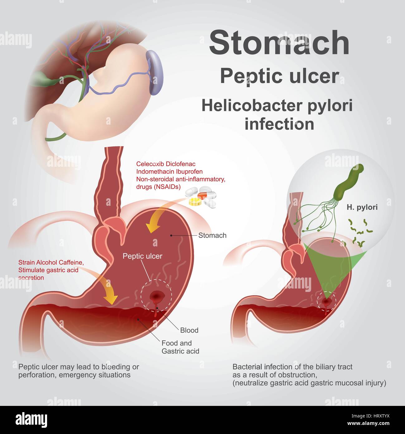 eptic ulcer disease, also known as a peptic ulcer or stomach ulcer, is a break in the lining of the stomach, first part of the small intestine, or occ Stock Vector