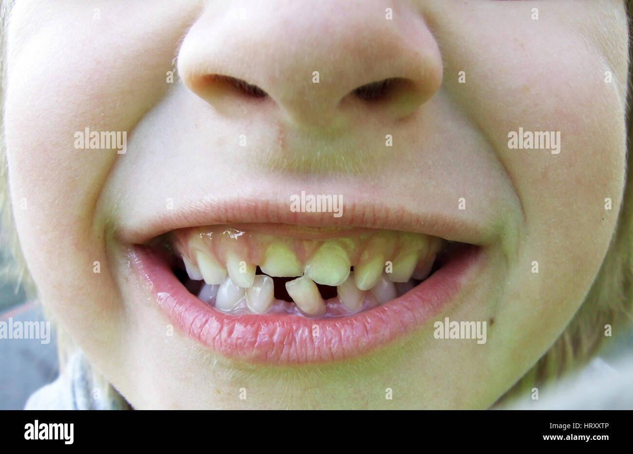 Gappy teeth Stock Photo - Alamy