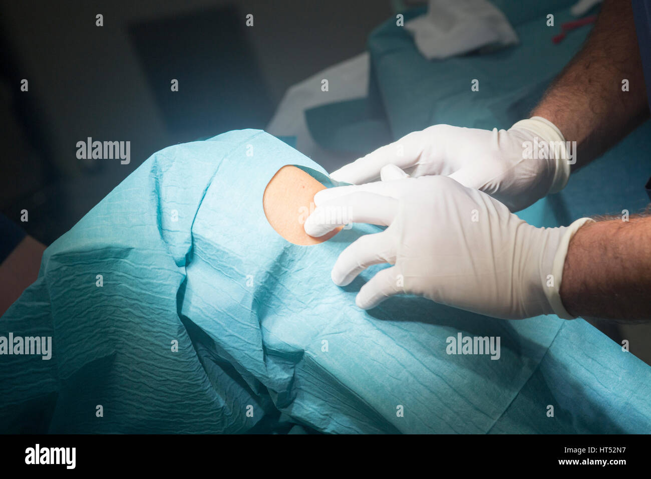 Preparing knee for surgery hospital operation medical procedure in emergency room operating theater. Stock Photo