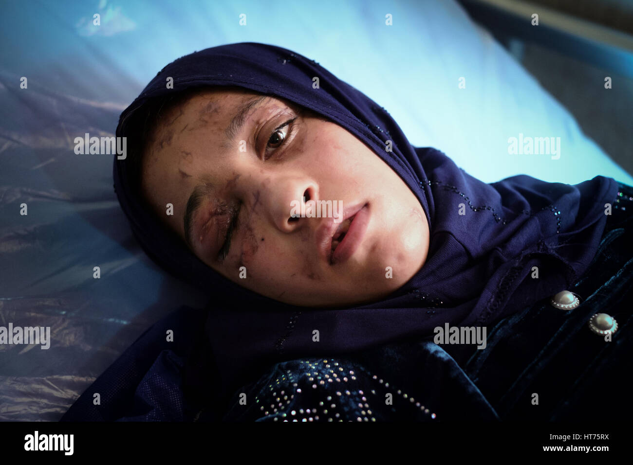 Injured Iraq civilian woman age 19 who lost her right arm and eye when a bomb fell on her house in during fighting to liberate Mosul, Iraq Stock Photo