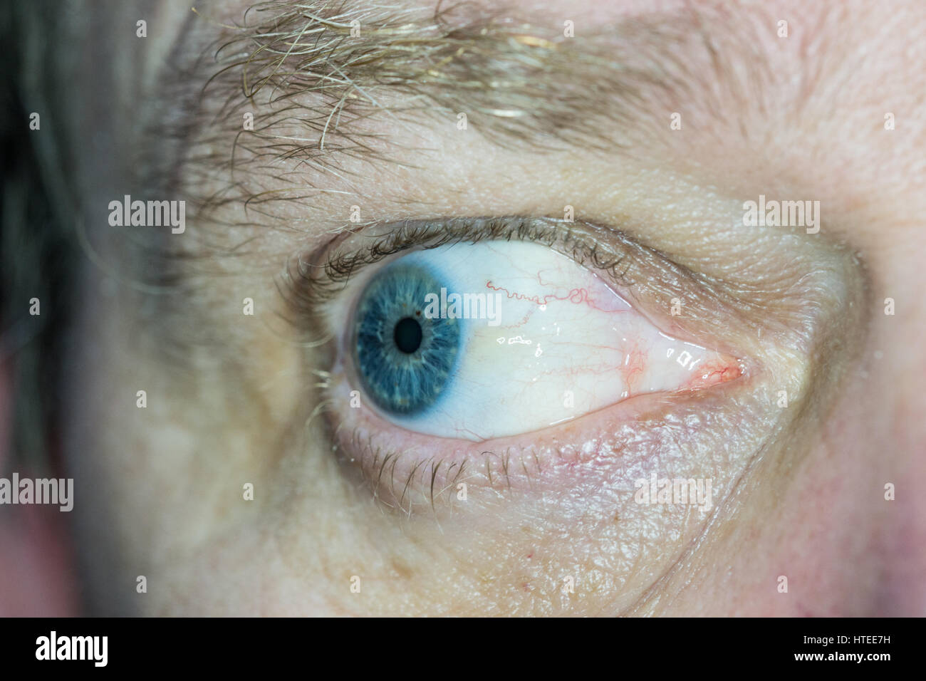 Sun burn damage to eye, known as Pinguecula causes a hardening lump on