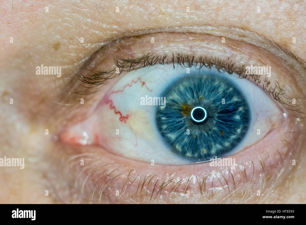 Sun burn damage to eye, known as Pinguecula causes a hardening lump on