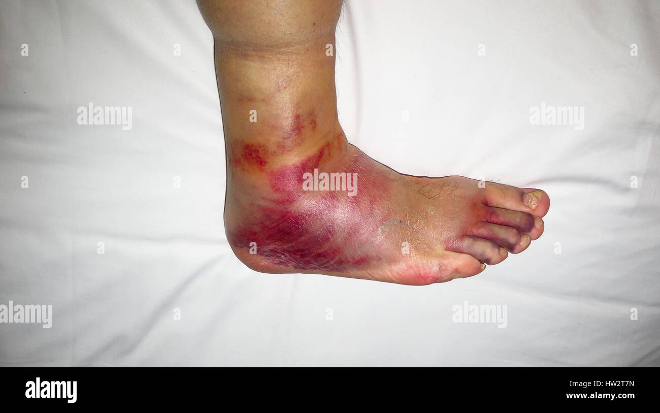 Broken ankle bruising on foot and ankle Stock Photo