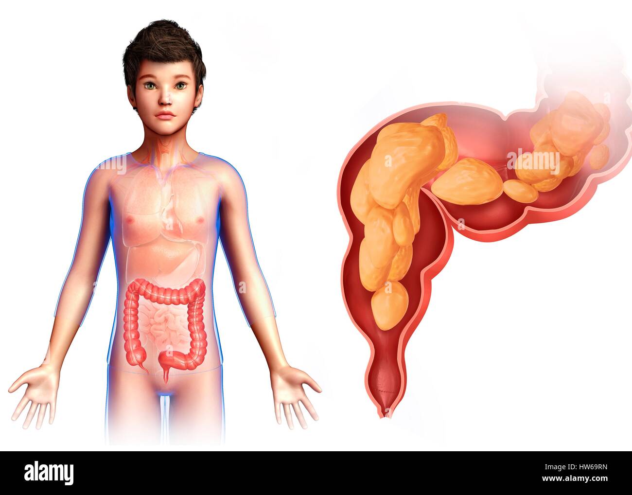 Illustration of a child's rectum. Stock Photo