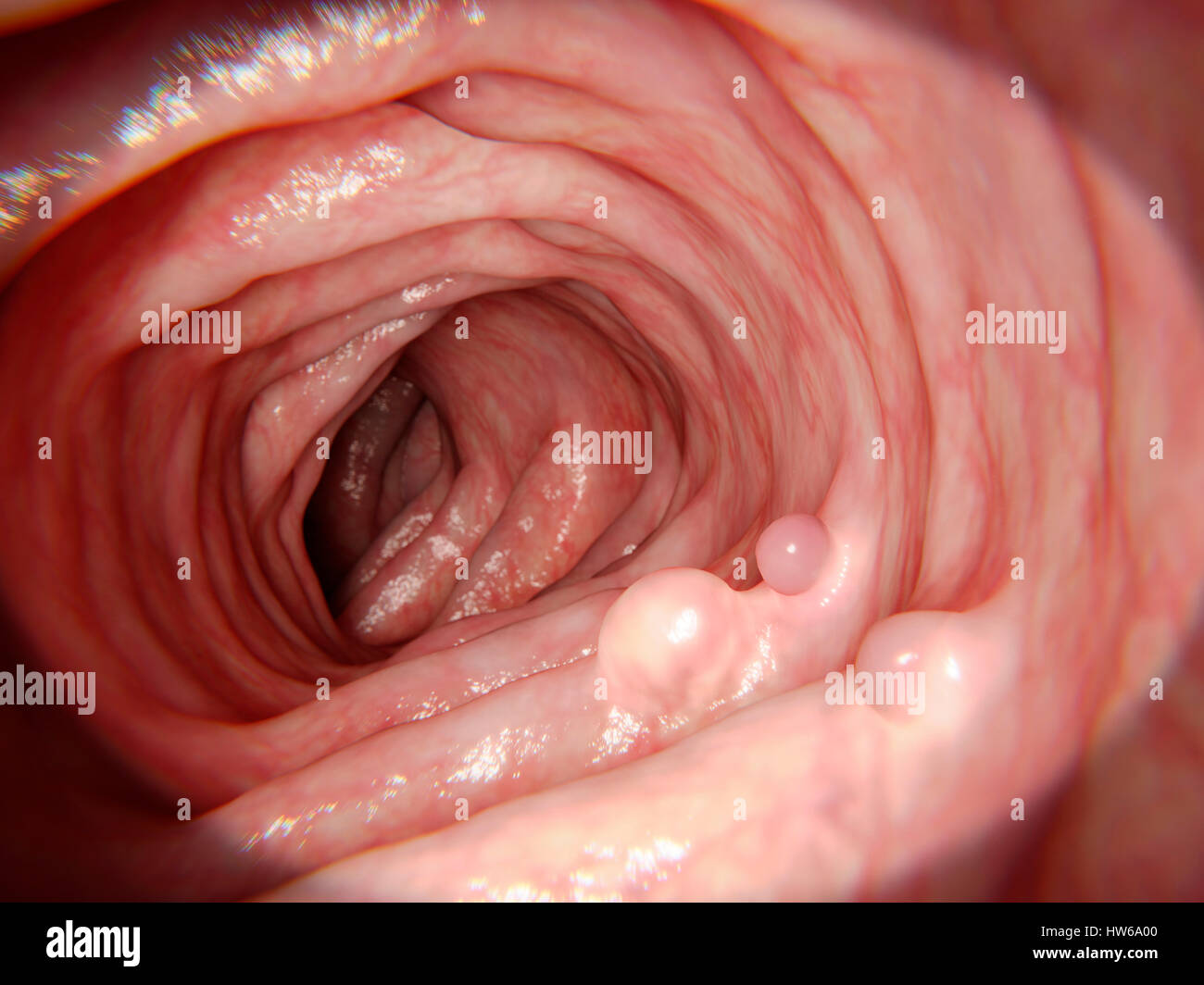 Computer illustration of polyps in the intestine. Polyps are small benign (non-cancerous) growths that arise from the mucus lining of the intestine. Polyps should be surgically removed as they may become malignant (cancerous). Stock Photo