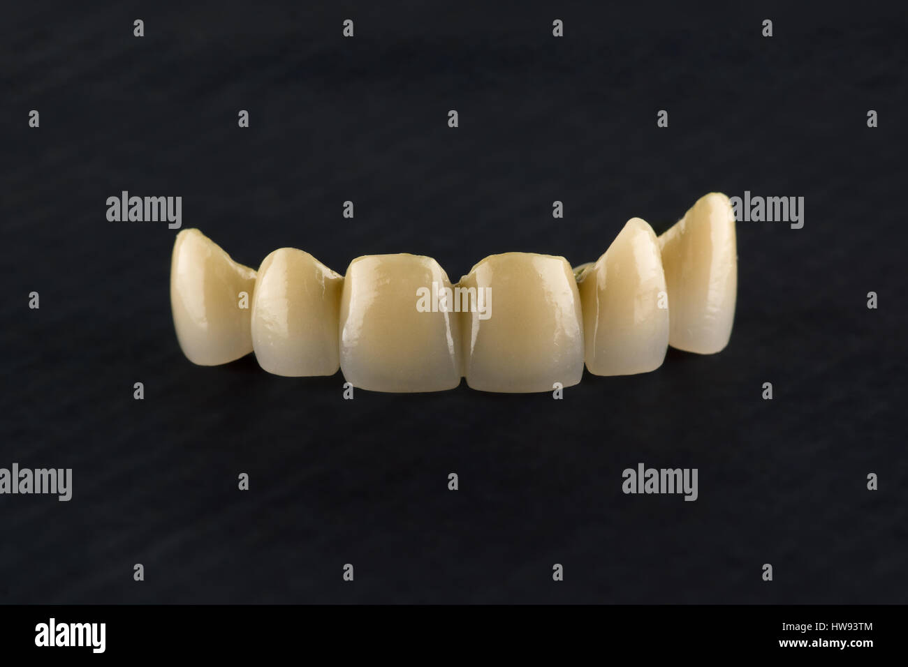 Metalceramic tooth crowns with locks for fixing removable prostheses