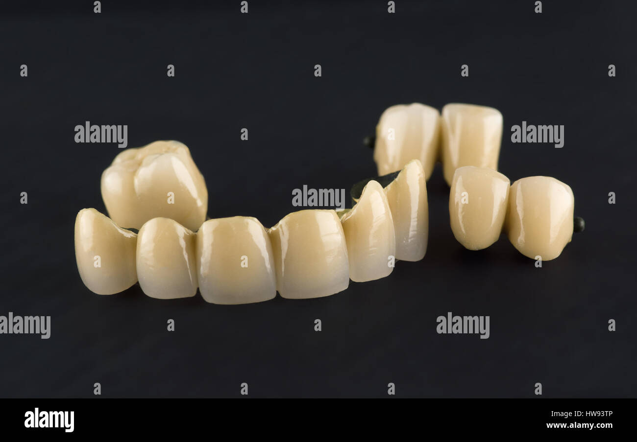 Зубной мост мостовидный протез. Металлокерамика коронки мост. Адгезивный мостовидный протез. Мостовидный протез металлокерамика. Металлопластмассовый мостовидный протез.