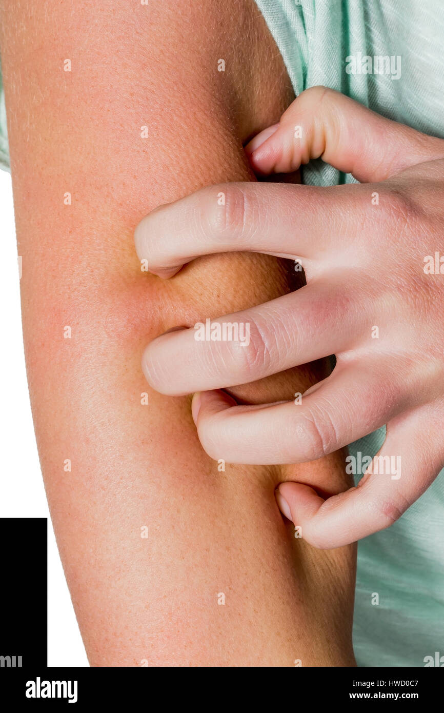 A woman has an itchy skin after a mosquito bite and scratches, Eine Frau hat nach einem M¸ckenstich eine juckende Haut und kratzt sich Stock Photo