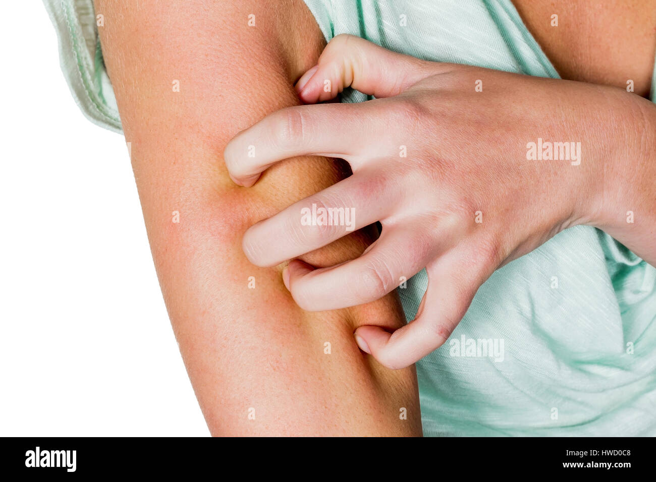 A woman has an itchy skin after a mosquito bite and scratches, Eine Frau hat nach einem M¸ckenstich eine juckende Haut und kratzt sich Stock Photo