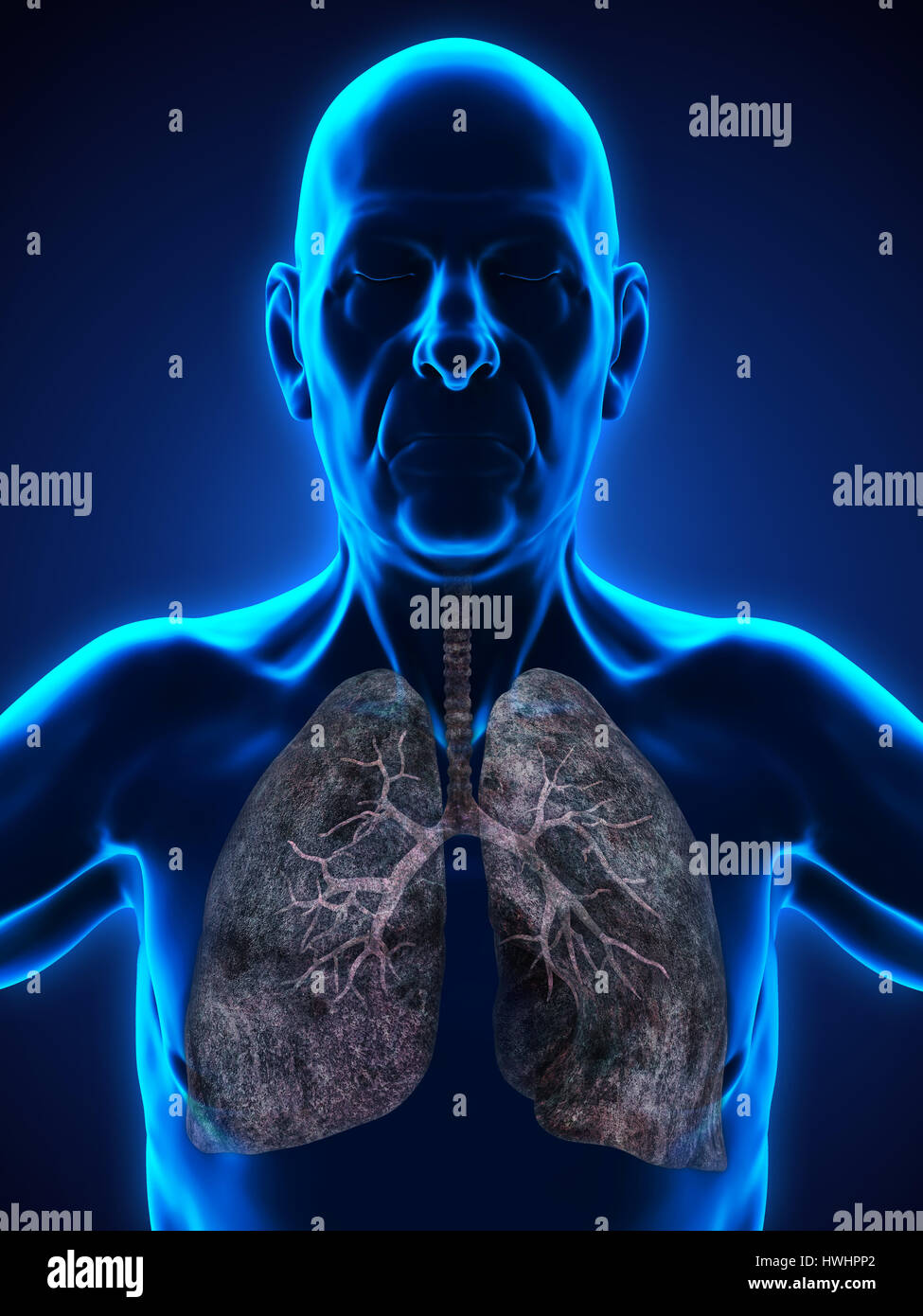 Elderly Male with Lung Cancer Illustration Stock Photo