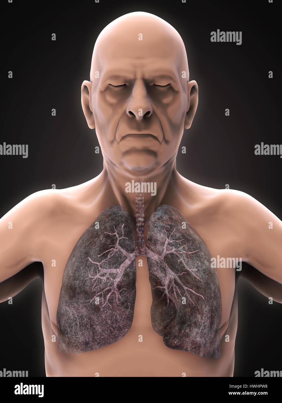 Elderly Male with Lung Cancer Illustration Stock Photo