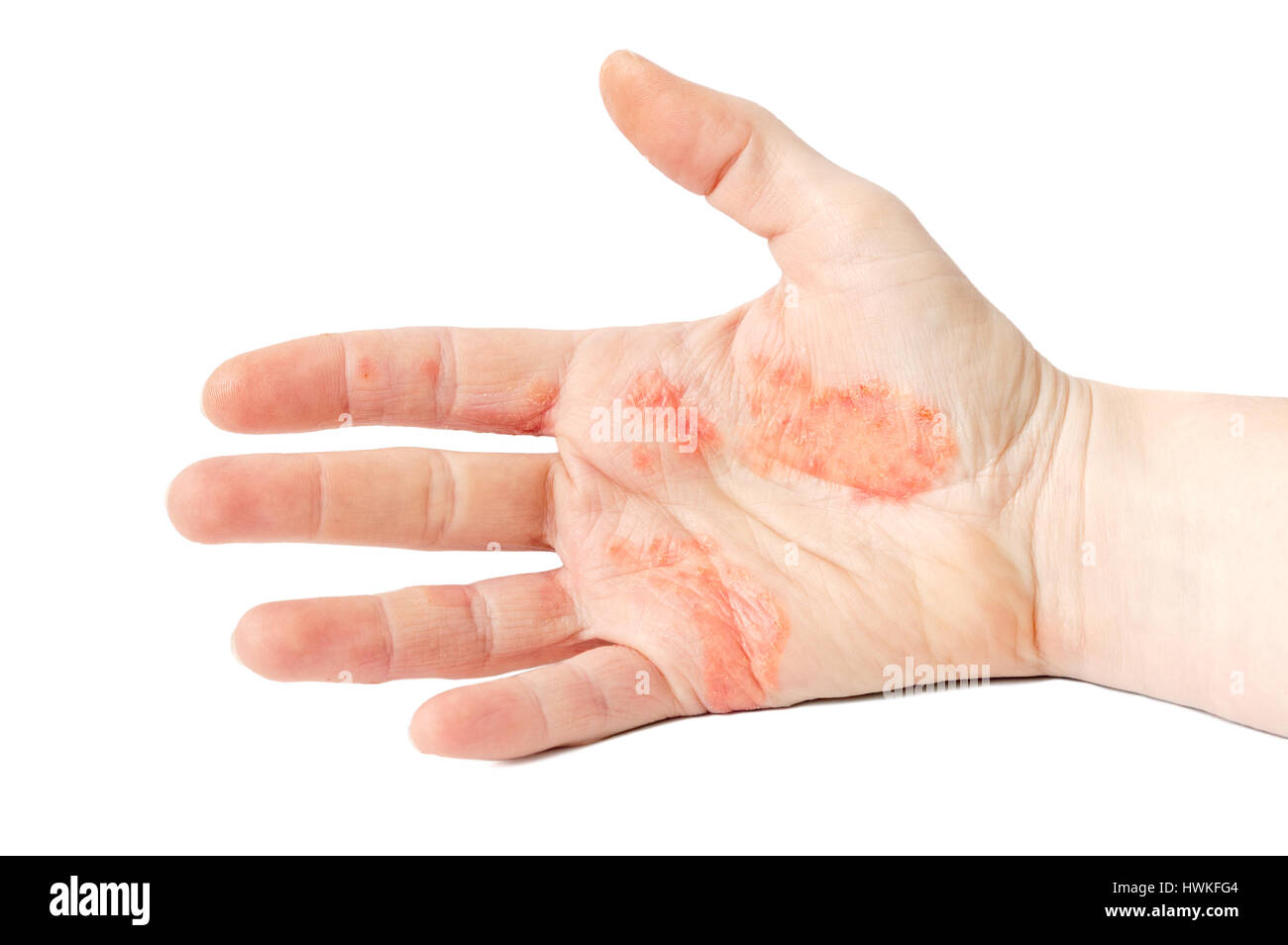 Close-up photo of a hand suffering of eczema Stock Photo
